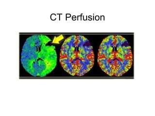 CT Perfusion
 