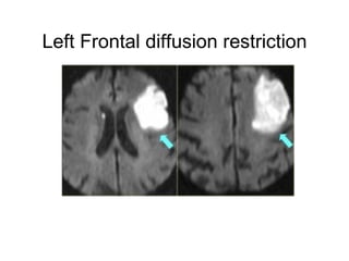 Left Frontal diffusion restriction
 