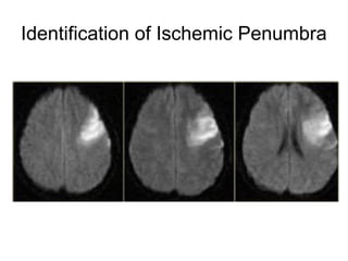 Identification of Ischemic Penumbra
 