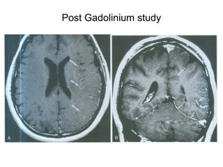 Post Gadolinium study
 