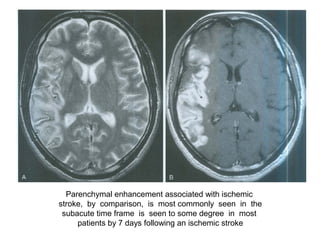 Parenchymal enhancement associated with ischemic
stroke, by comparison, is most commonly seen in the
subacute time frame is seen to some degree in most
patients by 7 days following an ischemic stroke
 