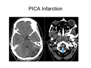 PICA Infarction
 