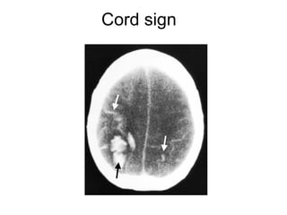 Cord sign
 
