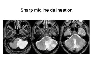 Sharp midline delineation
 