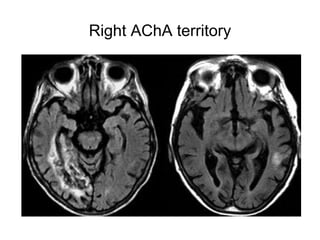 Right AChA territory
 