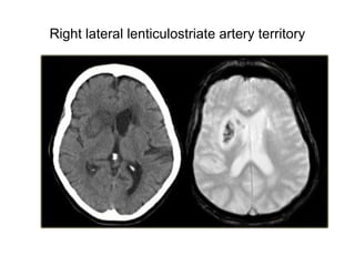 Right lateral lenticulostriate artery territory
 