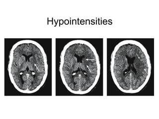Hypointensities
 