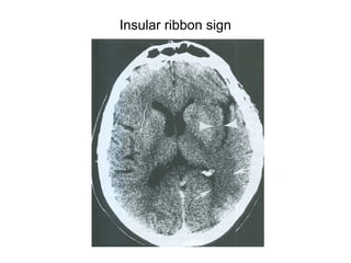 Insular ribbon sign
 