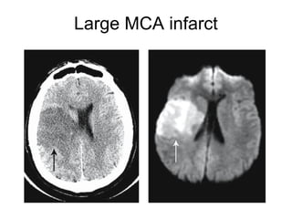 Large MCA infarct
 