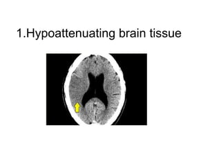 1.Hypoattenuating brain tissue
 