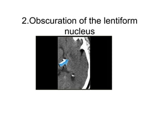 2.Obscuration of the lentiform
nucleus
 