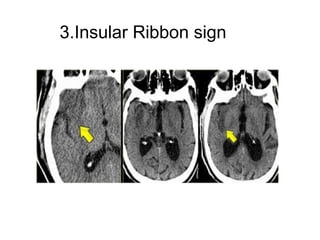 3.Insular Ribbon sign
 