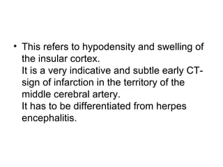 • This refers to hypodensity and swelling of
the insular cortex.
It is a very indicative and subtle early CT-
sign of infarction in the territory of the
middle cerebral artery.
It has to be differentiated from herpes
encephalitis.
 