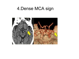 4.Dense MCA sign
 