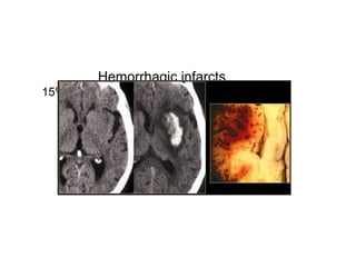 Hemorrhagic infarcts
15% of MCA infarcts are initially hemorrhagic.
 