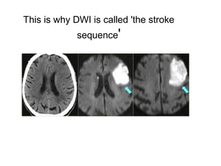 This is why DWI is called 'the stroke
sequence'
 