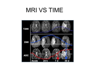 MRI VS TIME
 