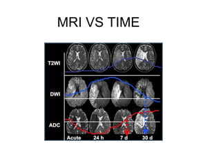 MRI VS TIME
 