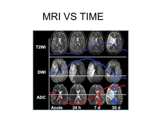 MRI VS TIME
 