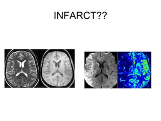 INFARCT??
 