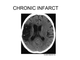 CHRONIC INFARCT
 