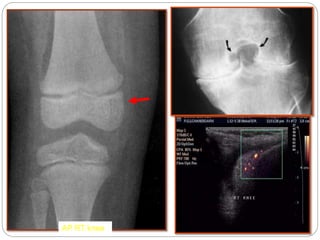 Pfd Rt Knee Imaging in arthritis | PPTX