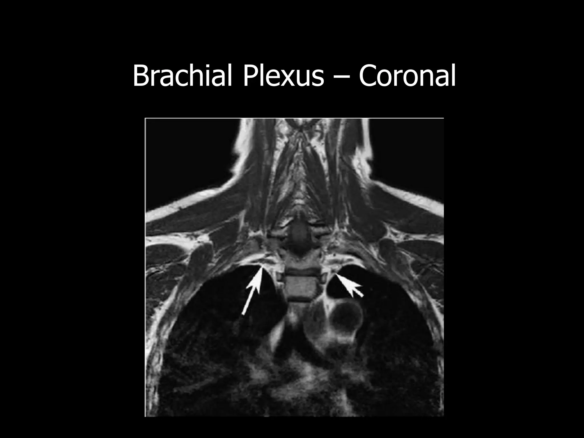 Brachial plexus MRI | PPTX