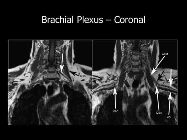 Brachial plexus MRI | PPTX