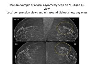 Here an example of a focal asymmetry seen on MLO and CC-
view.
Local compression views and ultrasound did not show any mass
 