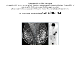 Here an example of global asymmetry.
In this patient this is not a normal variant, since there are associated features, that indicate the possibility of
malignancy like thickened septa and subtle nipple retraction.
Ultrasound (not shown) detected multiple small masses that proved to be adenocarcinoma.
The PET-CT shows diffuse infiltrating carcinoma
 