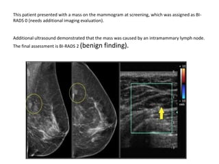 This patient presented with a mass on the mammogram at screening, which was assigned as BI-
RADS 0 (needs additional imaging evaluation).
Additional ultrasound demonstrated that the mass was caused by an intramammary lymph node.
The final assessment is BI-RADS 2 (benign finding).
 