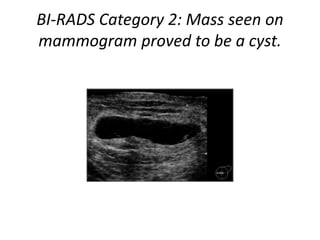 BI-RADS Category 2: Mass seen on
mammogram proved to be a cyst.
 