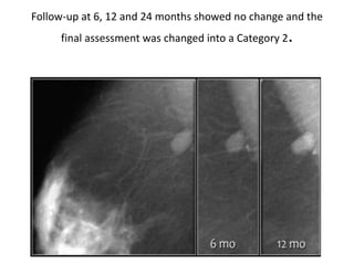 Follow-up at 6, 12 and 24 months showed no change and the
final assessment was changed into a Category 2.
 