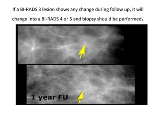 If a BI-RADS 3 lesion shows any change during follow up, it will
change into a BI-RADS 4 or 5 and biopsy should be performed.
 