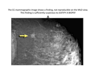 The CC mammographic image shows a finding, not reproducible on the MLO view.
This finding is sufficiently suspicious to JUSTIFY A BIOPSY
A
 