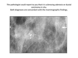 The pathologist could report to you that it is sclerosing adenosis or ductal
carcinoma in situ.
Both diagnoses are concordant with the mammographic findings.
 