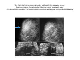 On the initial mammogram a marker is placed in the palpable tumor.
Due to the dense fibroglandular tissue the tumor is not well seen.
Ultrasound demonstrated a 37 mm mass with indistinct and angular margins and shadowing
 