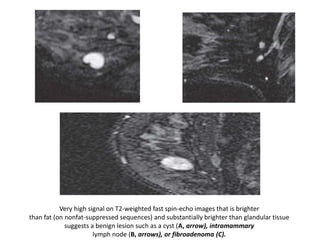 Very high signal on T2-weighted fast spin-echo images that is brighter
than fat (on nonfat-suppressed sequences) and substantially brighter than glandular tissue
suggests a benign lesion such as a cyst (A, arrow), intramammary
lymph node (B, arrows), or fibroadenoma (C).
 