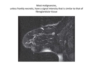 Most malignancies,
unless frankly necrotic, have a signal intensity that is similar to that of
fibroglandular tissue
 