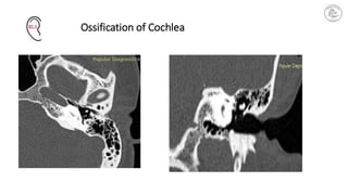 Imaging in Cochlear Implant Surgery: A Surgical Roadmap from CT–MRI to ...