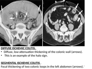 Imaging in colorectal diseases 3.pptx presentation | PPTX