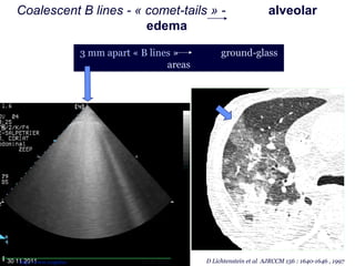 D Lichtenstein et al AJRCCM 156 : 1640-1646 , 199730 11 2011
Coalescent B lines - « comet-tails » - alveolar
edema
3 mm apart « B lines » ground-glass
areas
3 mm apart « B lines » ground-glass
areas
http://www.reapitie- 02 09 2012
 