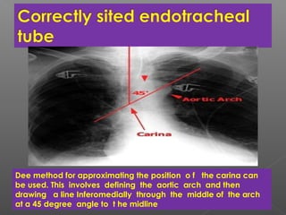 Dee method for approximating the position o f the carina can
be used. This involves defining the aortic arch and then
drawing a line Inferomedially through the middle of the arch
at a 45 degree angle to t he midline
 