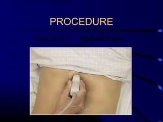 PROCEDURE
Approach #1 – Xiphoid View
 