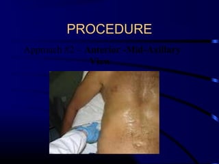 PROCEDURE
Approach #2 – Anterior -Mid-Axillary
View
 