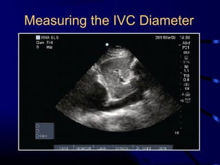 Measuring the IVC Diameter
Measure IVC 2cm
 