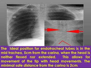 The Ideal position for endotracheal tubes is in the
mid trachea, 5cm from the carina, when the head is
neither flexed nor extended. This allows for
movement of the tip with head movements. The
minimal safe distance from the carina is 2cm.
 