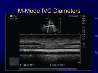 M-Mode IVC Diameters
 