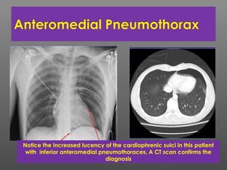 Notice the increased lucency of the cardiophrenic sulci in this patient
with inferior anteromedial pneumothoraces. A CT scan confirms the
diagnosis
 