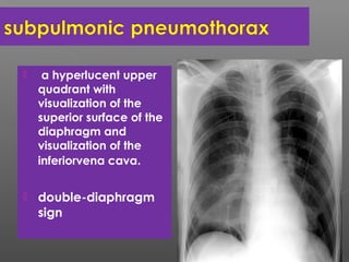  a hyperlucent upper
quadrant with
visualization of the
superior surface of the
diaphragm and
visualization of the
inferiorvena cava.
 double-diaphragm
sign
 